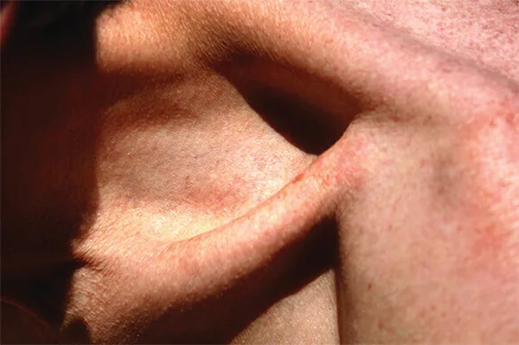 Ρήξη του μυοτενόντιου πετάλου του ώμου