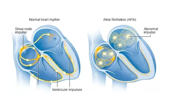 Κολπική Μαρμαρυγή