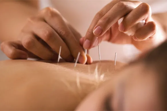 Βελονισμός και απώλεια βάρους