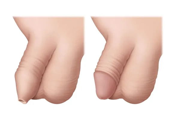 Περιτομή: Πιο απαραίτητη από ποτέ