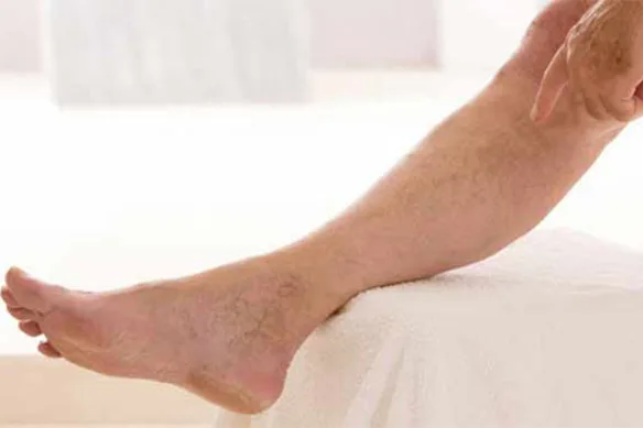 Φλεβική ανεπάρκεια κιρσοί