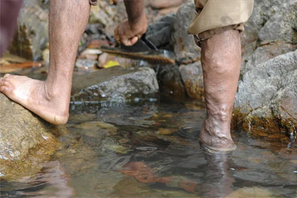 Λεμφοίδημα ή απλώς οίδημα;
