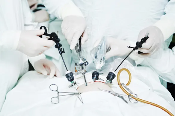 Λαπαροσκοπική αφαίρεση ευμεγέθους ενδοκοιλιακής κύστης