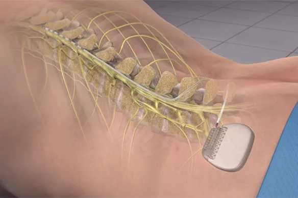 Τοποθέτηση νευροδιεγέρτη κατά της ακράτειας