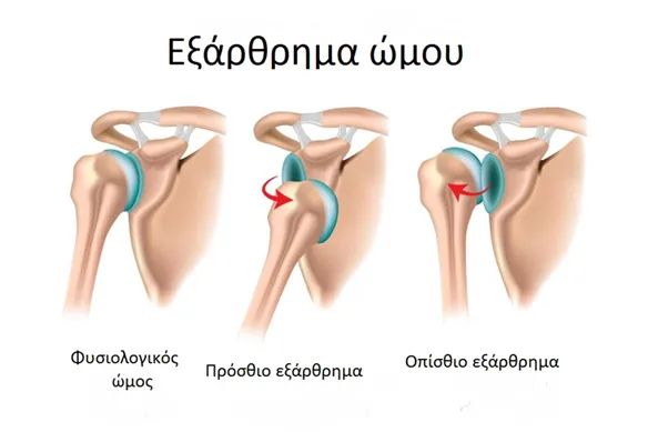 "Γιατρέ, ο ώμος μου βγαίνει" - Εξάρθρημα του ώμου