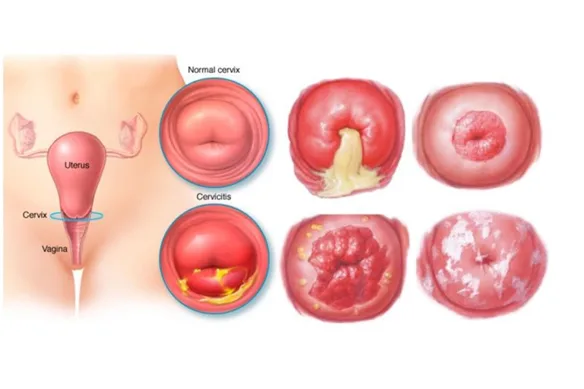 Τραχηλίτις