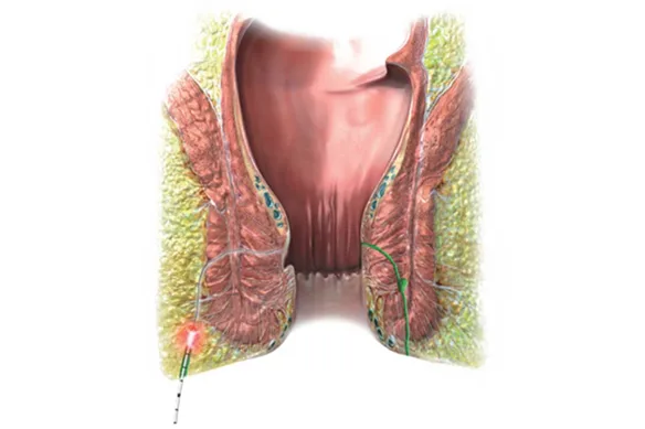 Περιεδρικό απόστημα και συρίγγιο