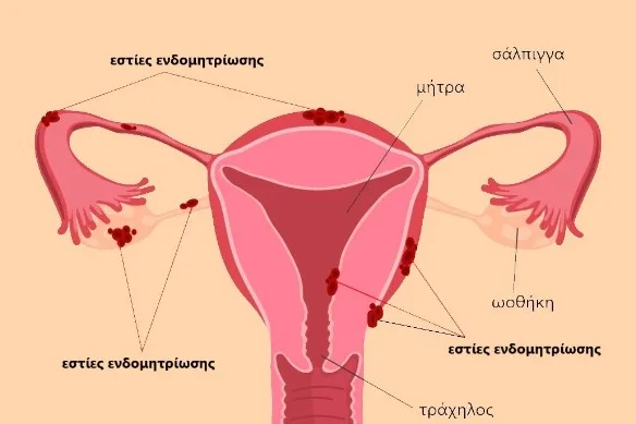 Ενδομητρίωση
