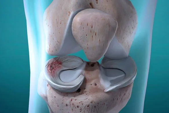 « Έχω μηνίσκο, είναι σοβαρό; »