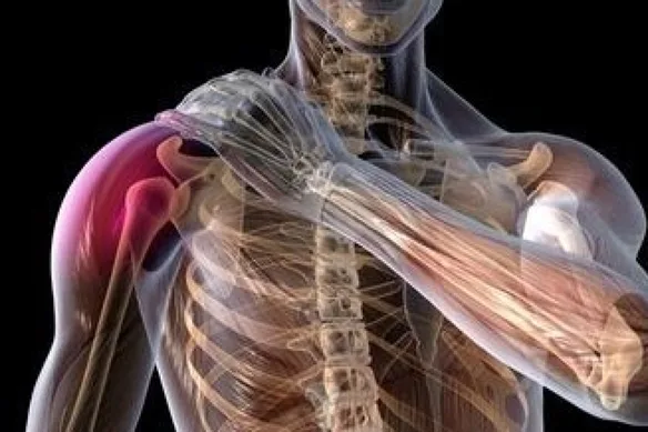 Τι είναι η ρήξη SLAP στον ώμο;