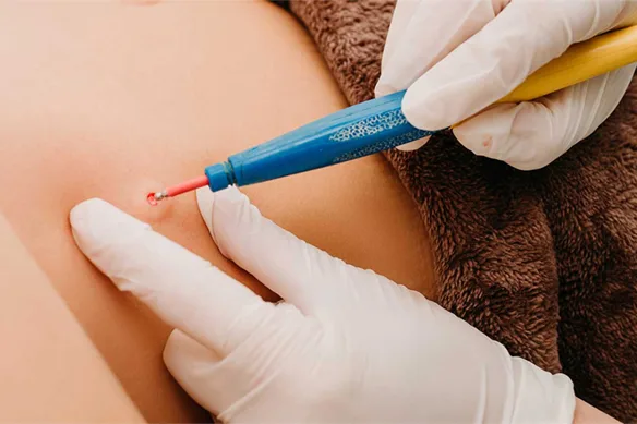 Κονδυλώματα