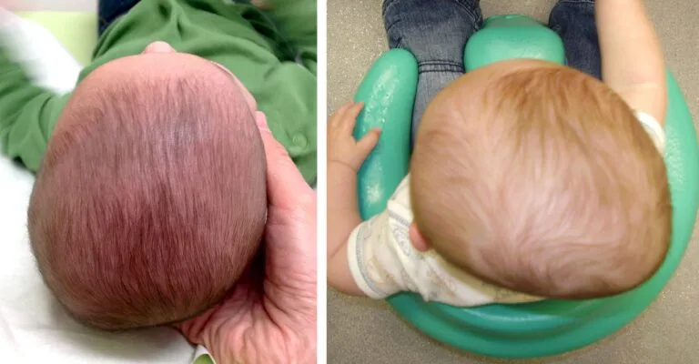 Πλαγιοκεφαλία, τι είναι και πώς αντιμεtωπίζεται;