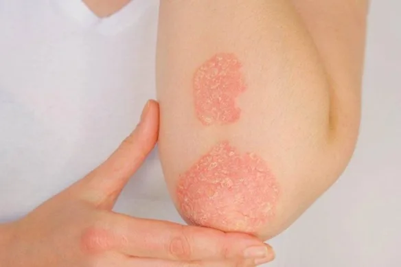 Αυτοάνοσα νοσήματα και ο ρόλος της ψυχολογίας στη θεραπεία τους